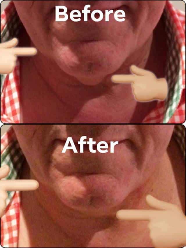 male before and after 3D HIFU double chin removal Sydney