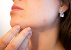 Best laser acne scar removal Sydney #1 price picosecond