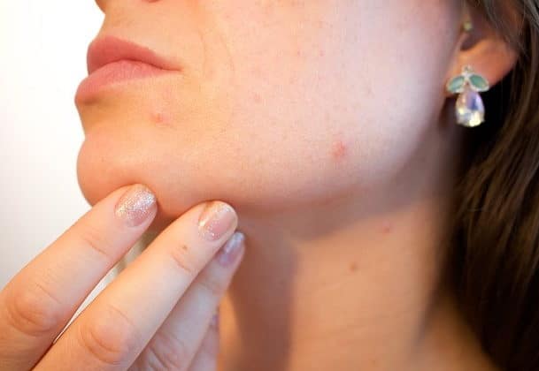 Best laser acne scar removal Sydney #1 price picosecond