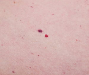 Red moles cherry angiomas removal Sydney gone in 1 treatment