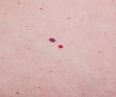 Red moles cherry angiomas removal Sydney best 1 treatment