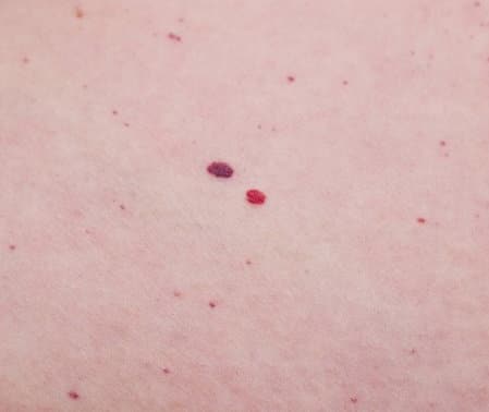 Red Moles Cherry Angiomas Removal Sydney Gone In 1 Treatment