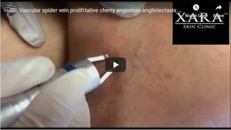 Vascular spider cherry vein removal Sydney