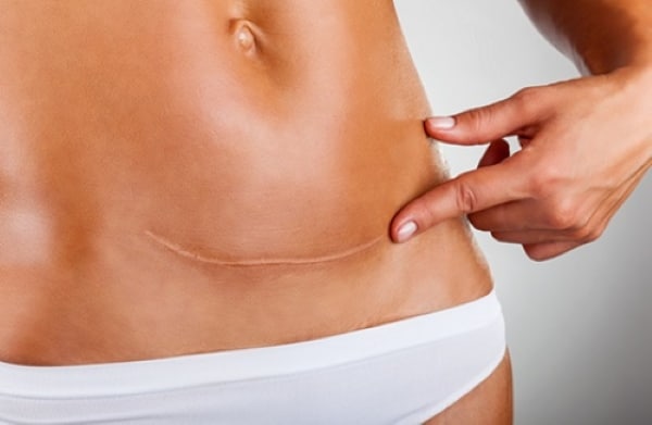 Mole cellulite scar fat removal North Sydney body shaping milia loose skin tag