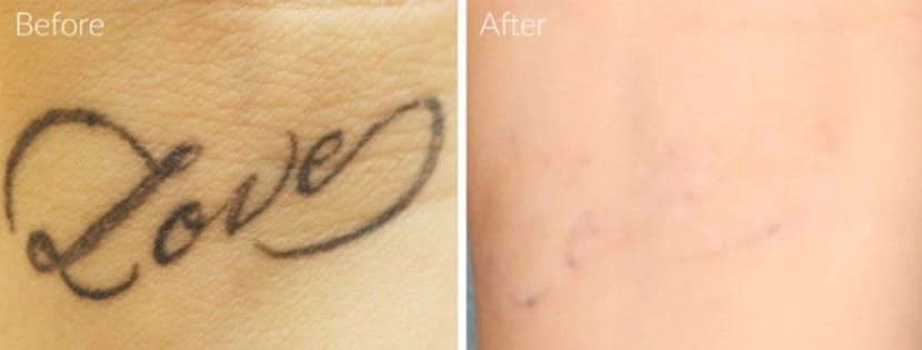 EMS clinic tattoo removal facial Turramurra body shaping beauty salon