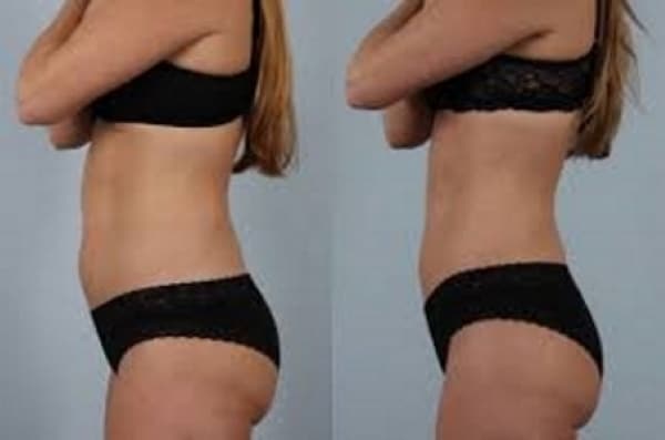 Fat freezing cavitation cool sculpting cryolipolysis laser liposuction Gladesville