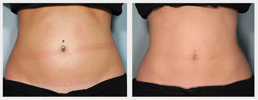 Fat freezing fat cavitation cool sculpting cryolipolysis laser liposuction Rose Bay