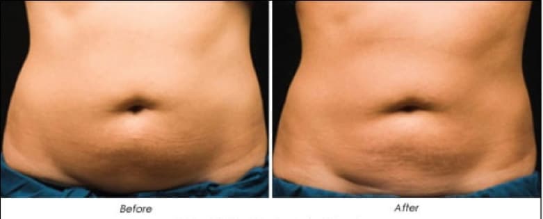 Laser fat removal reduction Sydney #1 best great price value