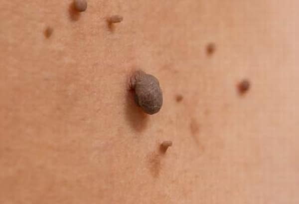 Mole cellulite scar fat removal Parramatta body shaping loose skin tag milia