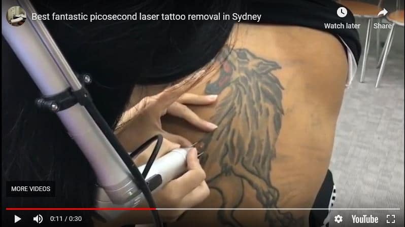 Best effective painless laser tattoo removal Sydney