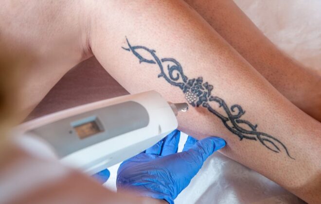 Laser Tattoo removal process getting rid of your tattoo