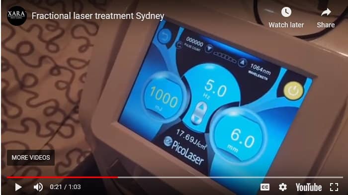 Fractional laser treatments Lane Cove 1