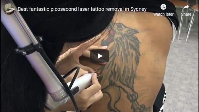 Experts in pico laser tattoo removal treatments Sydney