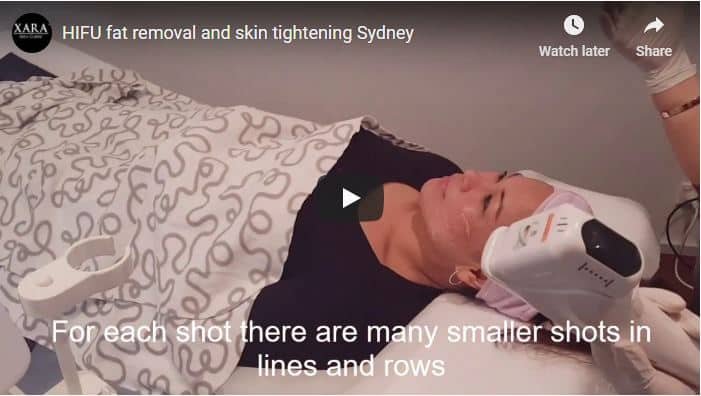 HIFU video fat reduction skin lifting Sydney