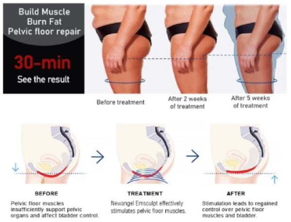 Build muscle burn fat pelvic floor repair