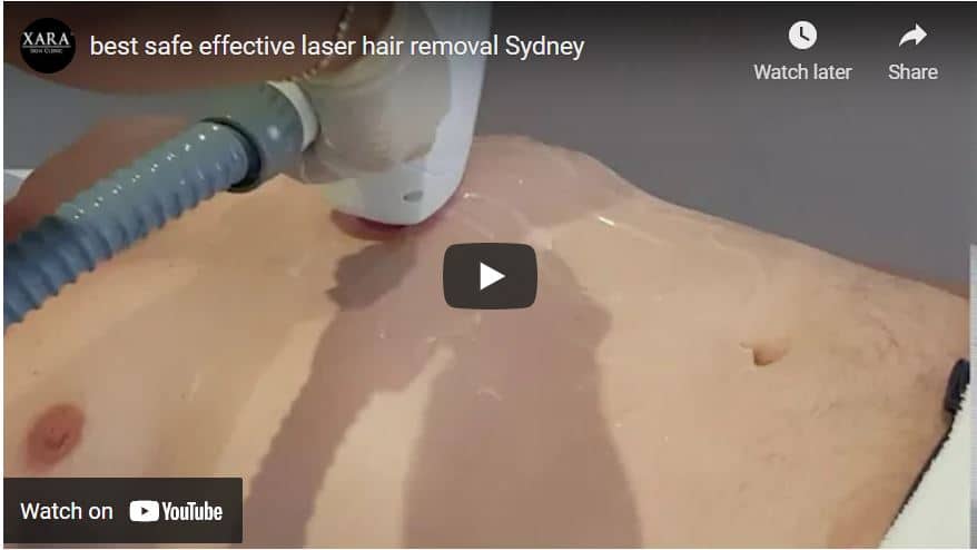 Great diode laser hair removal treatments