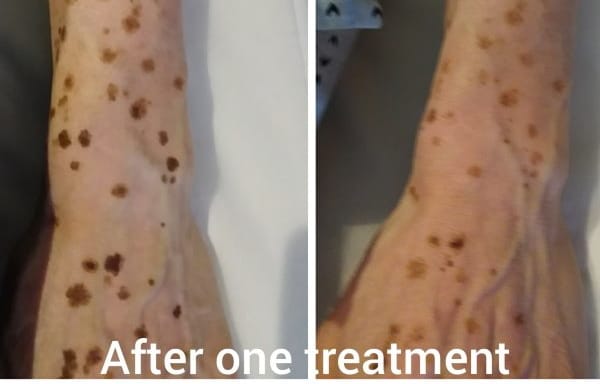 Sun Spot Age Spots Pigmentation Removal