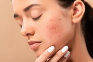5 Proven tips for fighting acne - best ideas treatments
