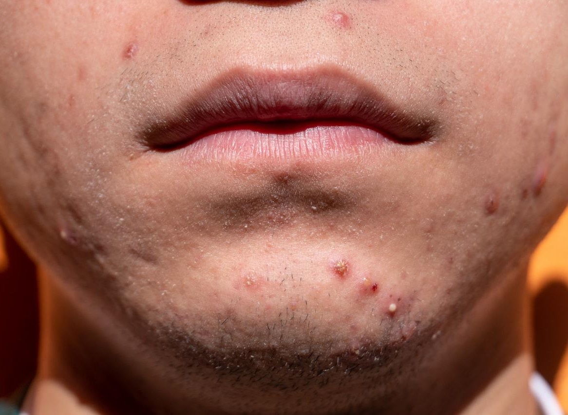 Acne scar removal Sydney – Better scars reduction treatments