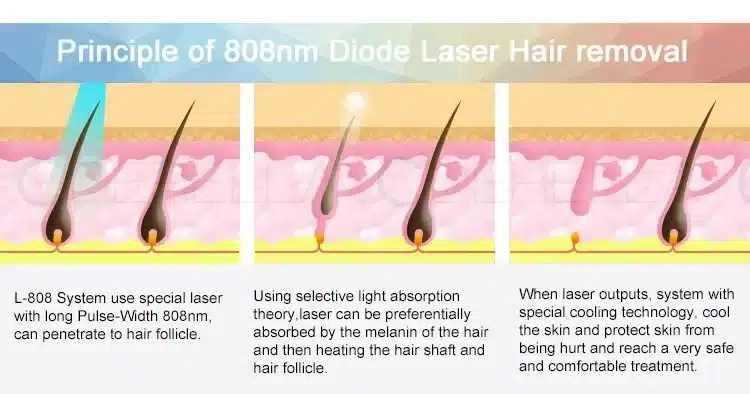 Fat diode laser hair removal in Lane Cove